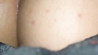 Fisting anal - Prolapse anal